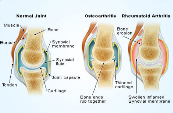 ArthritisW